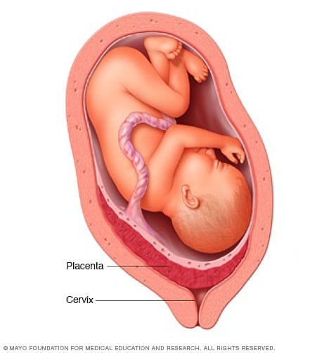 placenta-previa-mayo-clinic